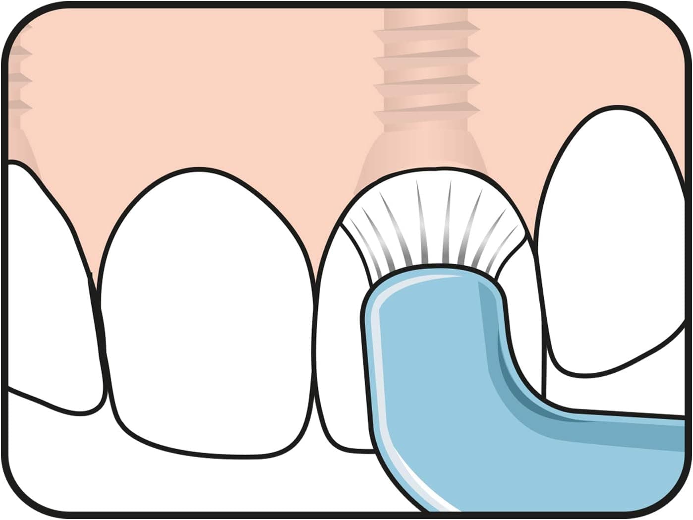 مسواک تکدسته TePe Compact Tuft با برس گرد مناسب ایمپلنت و پروتز، رنگهای متنوع مسواک تکدسته TePe Compact Tuft با برس گرد مناسب ایمپلنت و پروتز، رنگهای متنوع
