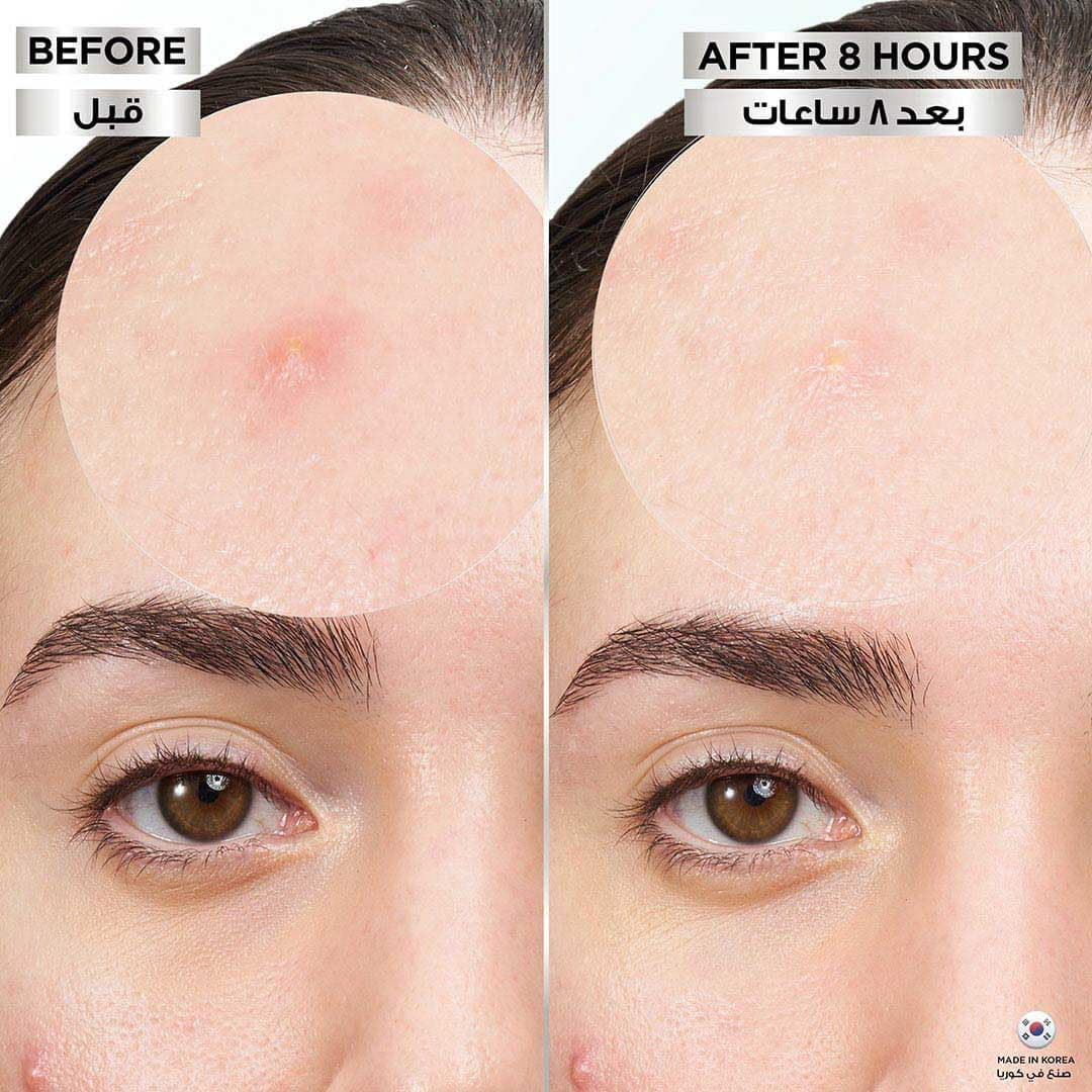 پچ جوش نامرئی Garnier Skinactive Fast Clear 8 Hours 22 عددی x1 پچ جوش نامرئی Garnier Skinactive Fast Clear 8 Hours 22 عددی x1